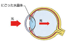 白内障の眼球