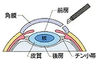 治療法1